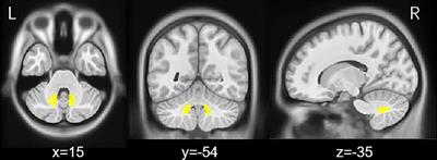 Altered functional connectivity of cerebellar dentate nucleus in peak-dose dyskinesia in Parkinson’s disease